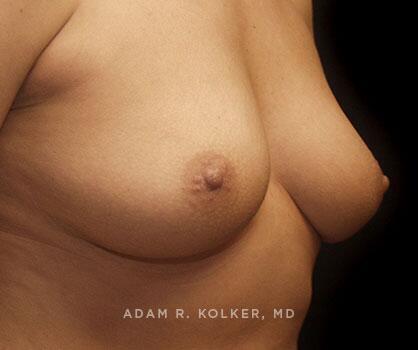 Inverted Nipple Correction After Image Patient 05 Oblique View