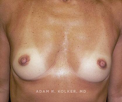 Inverted Nipple Correction After Image Patient 07 Front View