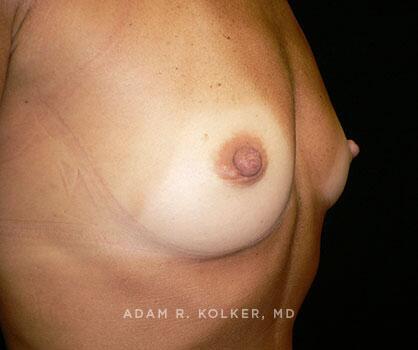 Inverted Nipple Correction After Image Patient 07 Oblique View