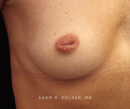 Inverted Nipple Correction Before Image Patient 07 Side View
