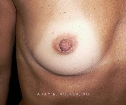 Inverted Nipple Correction After Image Patient 07 Side View
