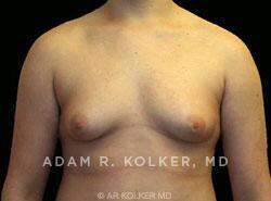Gynecomastia / Male Breast Reduction After Image Patient 01 Front View