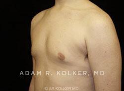 Gynecomastia / Male Breast Reduction After Image Patient 01 Oblique View