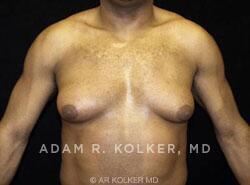 Gynecomastia Surgery Before Image Patient 02 Front View