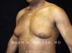 Gynecomastia / Male Breast Reduction Before and After Image