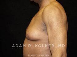 Gynecomastia Surgery Before Image Patient 02 Side View