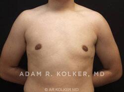 Gynecomastia / Male Breast Reduction After Image Patient 03 Front View