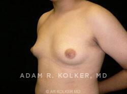 Gynecomastia / Male Breast Reduction After Image Patient 03 Oblique View