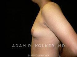 Gynecomastia / Male Breast Reduction After Image Patient 03 Side View