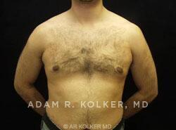 Gynecomastia / Male Breast Reduction After Image Patient 04 Front View
