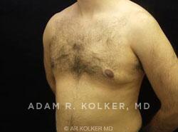 Gynecomastia / Male Breast Reduction After Image Patient 04 Oblique View