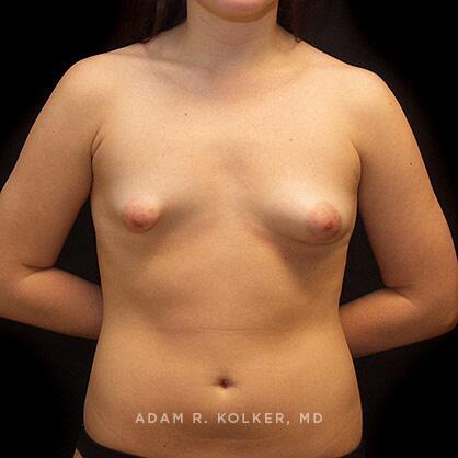 Tuberous Breast Correction Before Image Patient 01 Front View