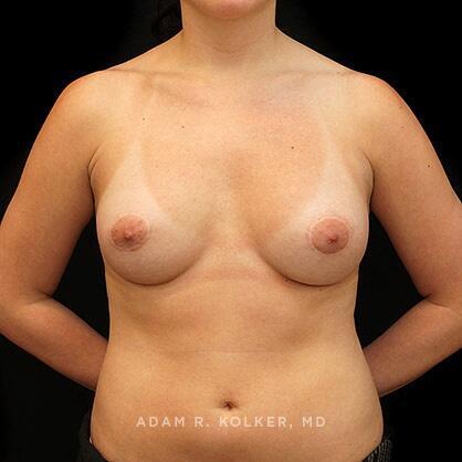 Tuberous Breast Correction After Image Patient 01 Front View