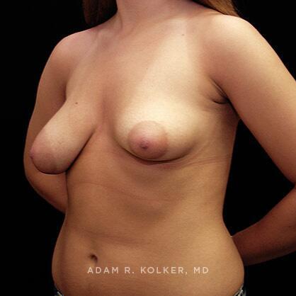 Tuberous Breast Correction After Image Patient 03 Oblique View