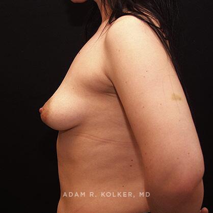 Tuberous Breast Correction Before Image Patient 06 Side View