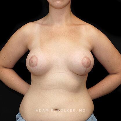 Tuberous Breast Correction After Image Patient 07 Front View