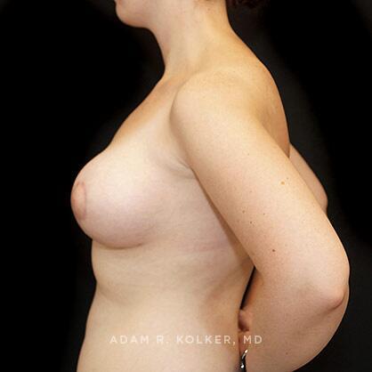 Tuberous Breast Correction After Image Patient 07 Side View
