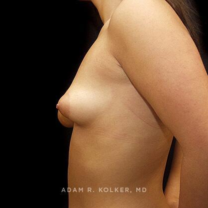 Tuberous Breast Correction Before Image Patient 08 Side View