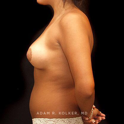 Tuberous Breast Correction Before and After Image