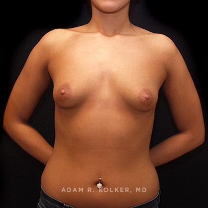 Tuberous Breast Correction Before Image Patient 11 Front View