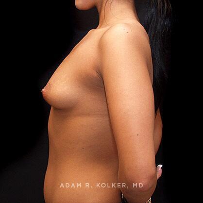 Tuberous Breast Correction After Image Patient 11 Side View