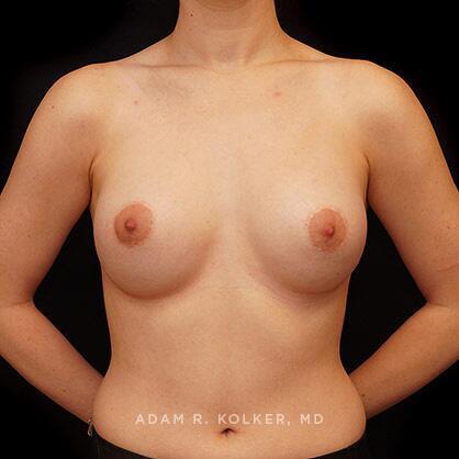 Tuberous Breast Correction After Image Patient 15 Front View