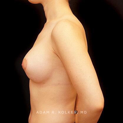 Tuberous Breast Correction After Image Patient 15 Side View