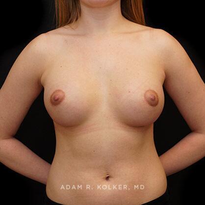 Tuberous Breast Correction After Image Patient 16 Front View