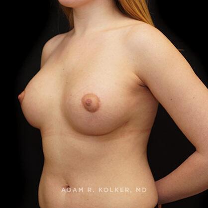 Tuberous Breast Correction After Image Patient 16 Oblique View