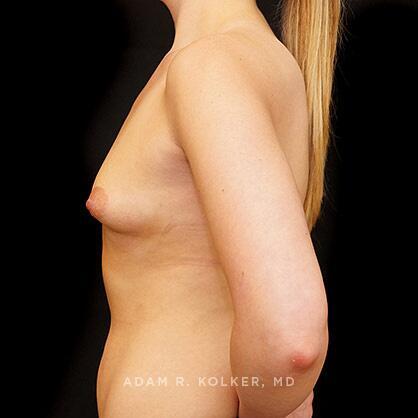 Tuberous Breast Correction Before Image Patient 16 Side View