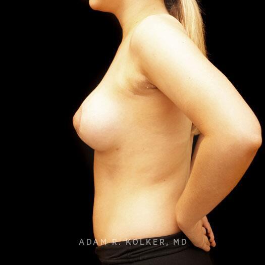 Tuberous Breast Correction After Image Patient 18 Side View