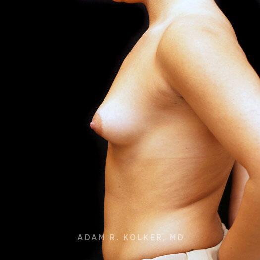 Tuberous Breast Correction Before Image Patient 21 Side View