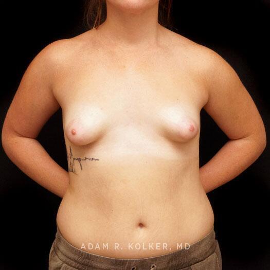 Tuberous Breast Correction Before Image Patient 24 Front View