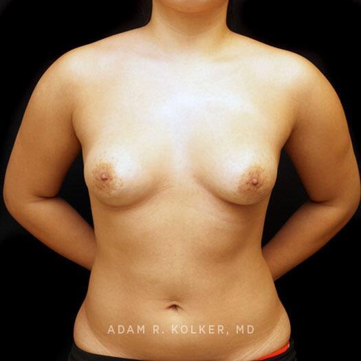 Tuberous Breast Correction Before Image Patient 26 Front View