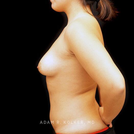 Tuberous Breast Correction Before Image Patient 26 Side View