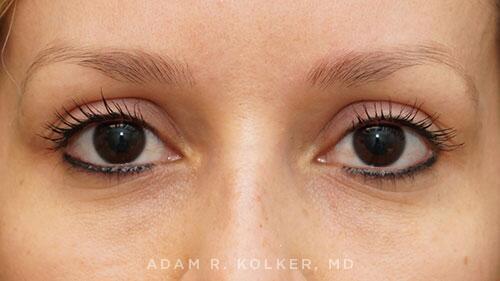 Blepharoplasty After Image Patient 01 Front View