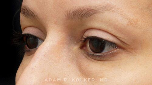 Blepharoplasty Before Image Patient 01 Oblique View