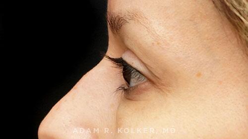 Blepharoplasty Before Image Patient 01 Side View