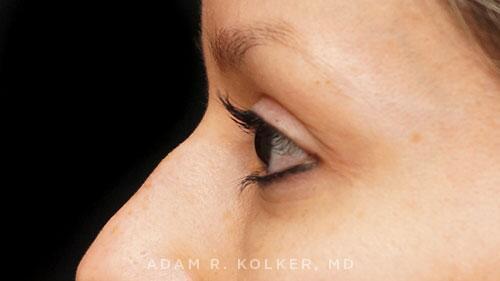 Blepharoplasty After Image Patient 01 Side View