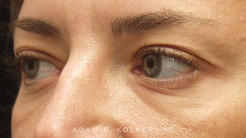 Blepharoplasty Before Image Patient 02 Oblique View
