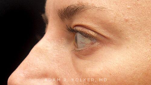 Blepharoplasty Before Image Patient 02 Side View