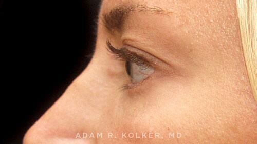 Blepharoplasty After Image Patient 02 Side View