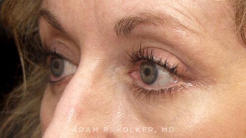 Blepharoplasty Before and After Image