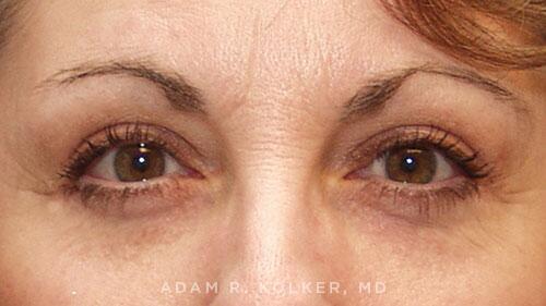 Blepharoplasty After Image Patient 09 Front View