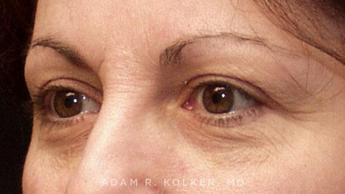 Blepharoplasty Before Image Patient 09 Oblique View