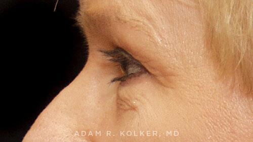 Blepharoplasty Before Image Patient 13 Side View