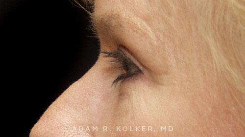 Blepharoplasty After Image Patient 13 Side View