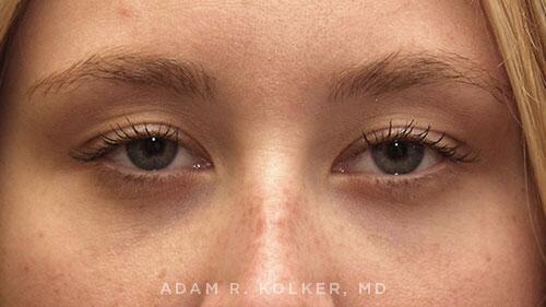 Blepharoplasty After Image Patient 14 Front View
