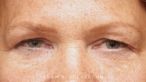 Blepharoplasty Before Image Patient 15 Front View