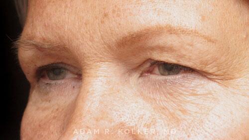 Blepharoplasty Before Image Patient 15 Oblique View